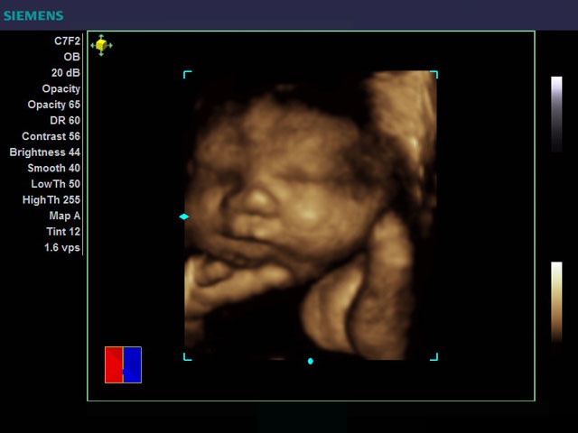 OB-–-36-Weeks-Fetal-Face